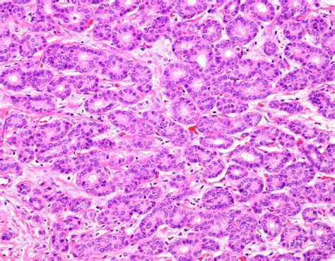 webpathology breast.